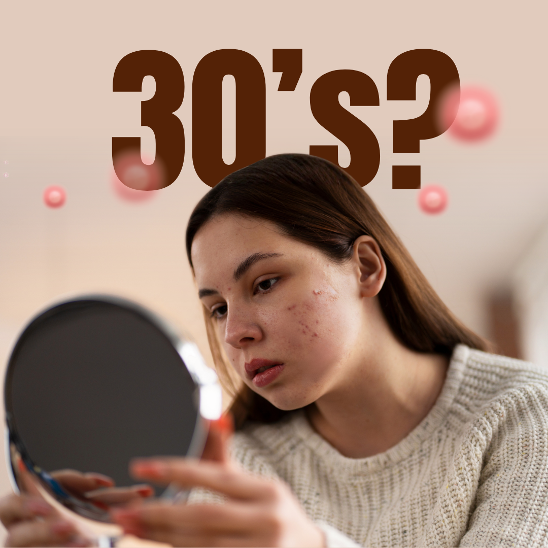 Having Pimples in your 30’s? It is Actually a Message from Your Gut
